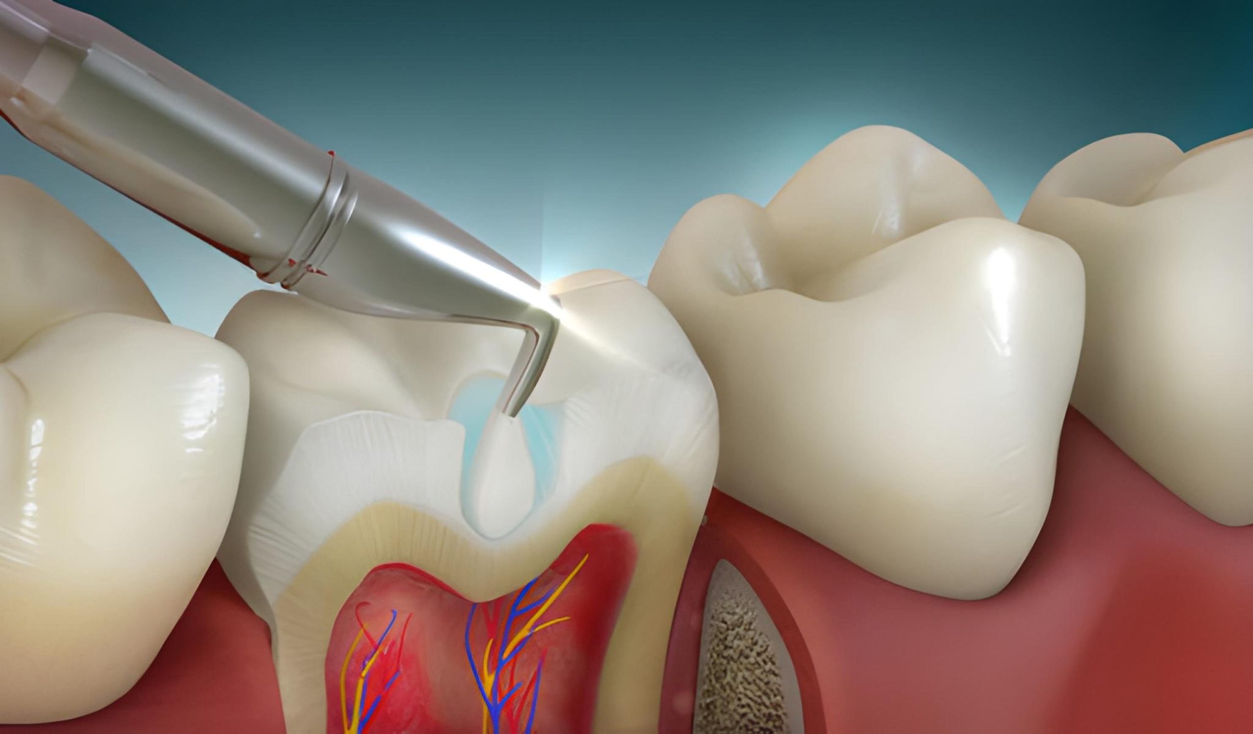 Dental Fillings in Leduc