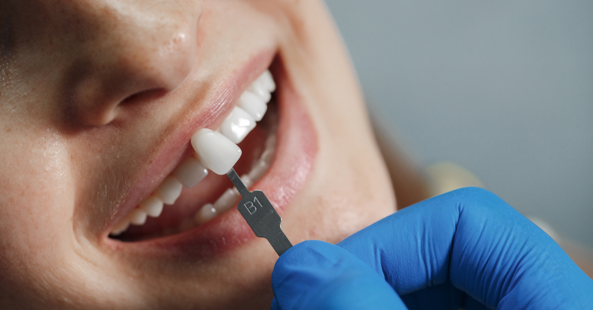 which type of dental crown is best for front teeth